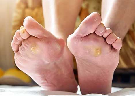 Diabetic Feet